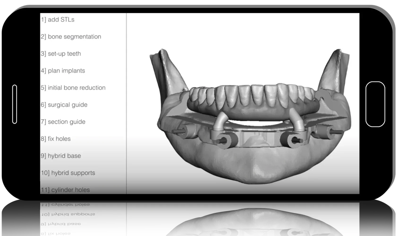 Advanced Surgical Guides - All on X