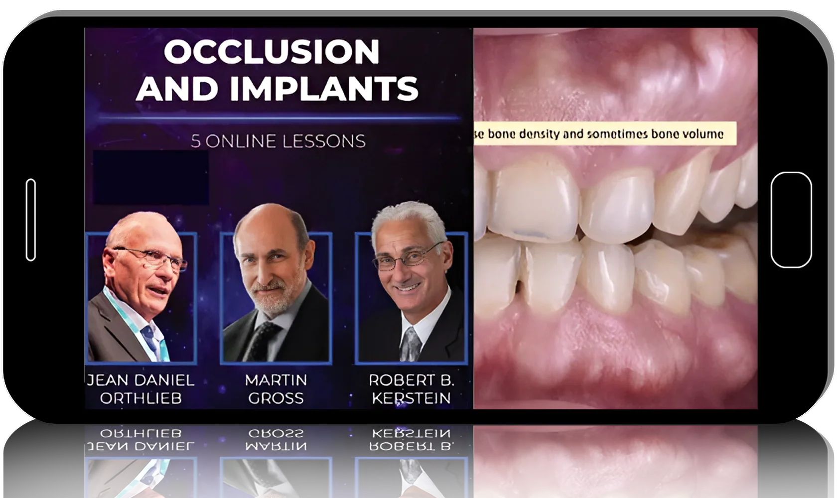 Occlusion and Implants