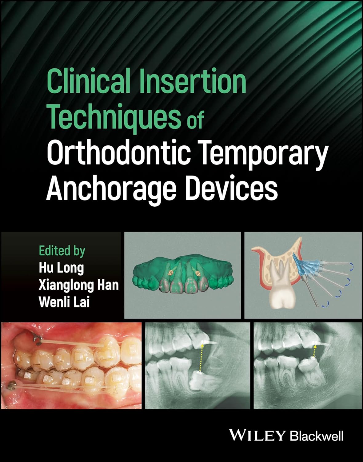 Clinical Insertion Techniques of Orthodontic Temporary Anchorage Devices, 1st Edition
