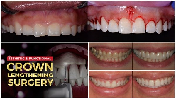 Esthetic and Functional Crown Lengthening Course - Dentistry eBooks