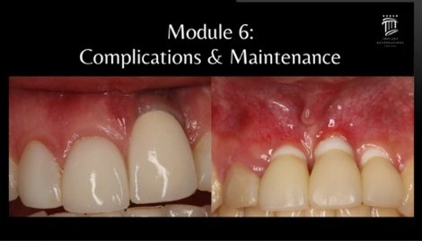 Implant Restorations Simplified: Restore Dental Implants with Accuracy & Confidence (Surgical Master) - Dentistry eBooks