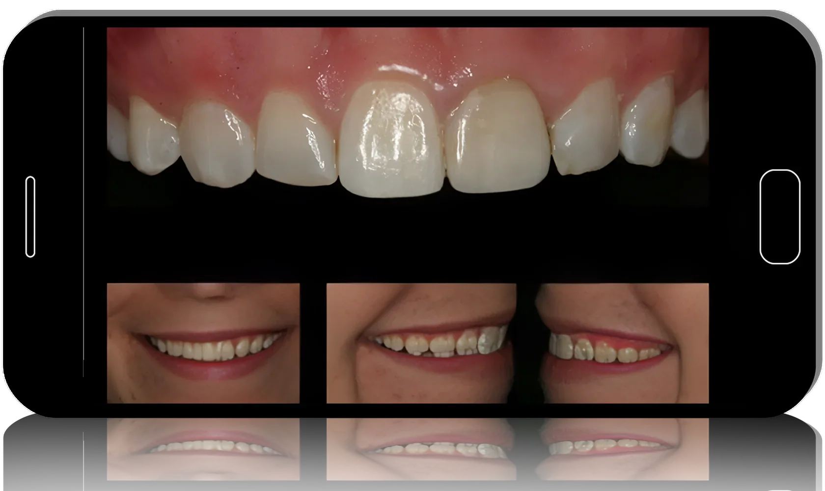 Surgical Master: Esthetic and Functional Crown Lengthening
