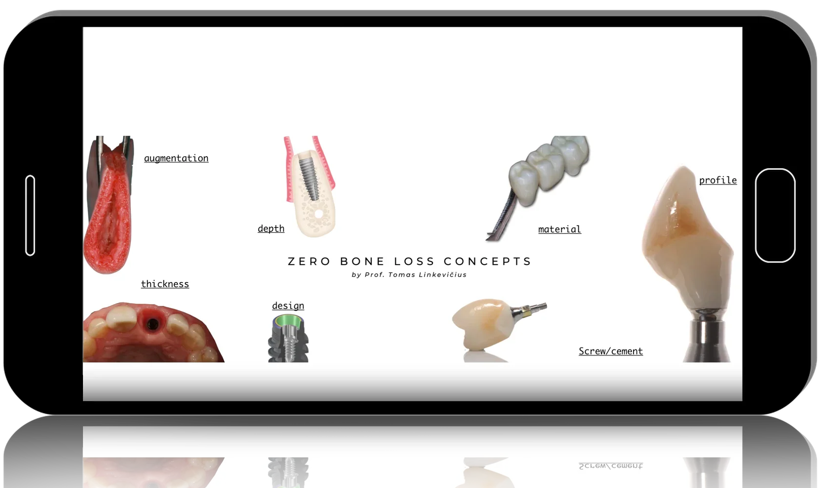 Zero Bone Loss Concepts - How to develop and maintain crestal bone stability
