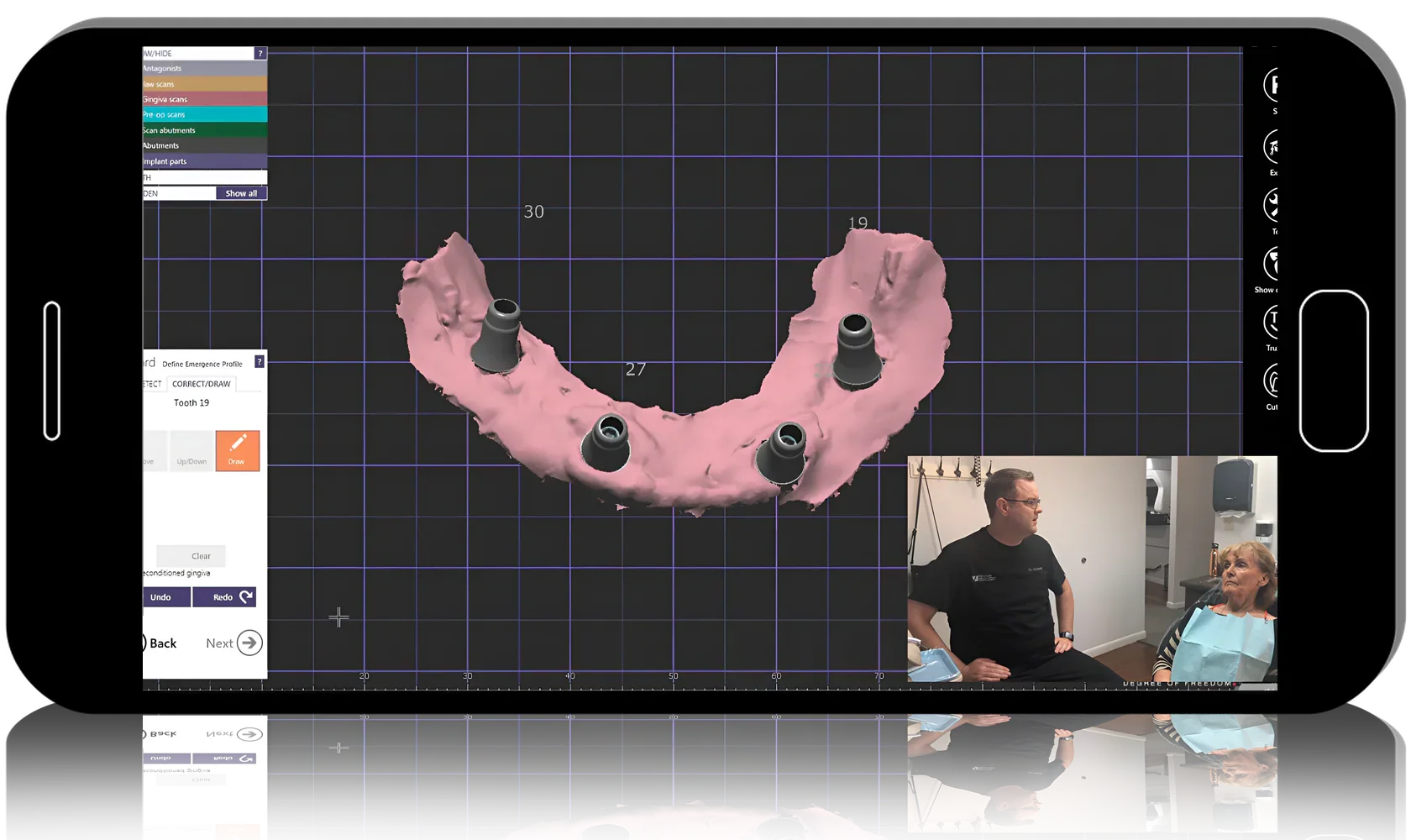 AOX Crystal Ultra Hybrid Restoration – ALL Clinical & Lab Steps Start to Finish