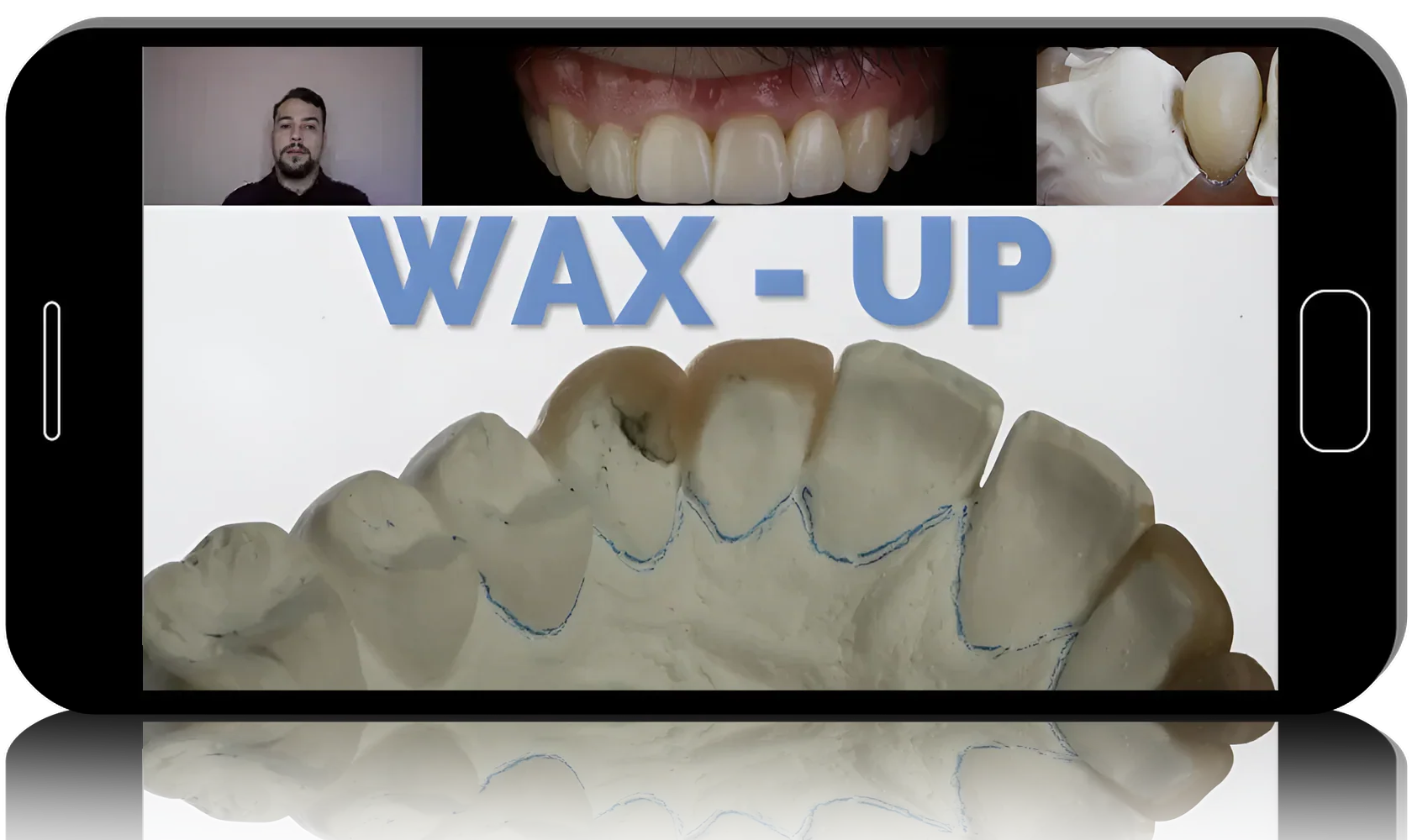 Injectable Technique: Composites Veneers, Comprehensive Online MasterClass 2022