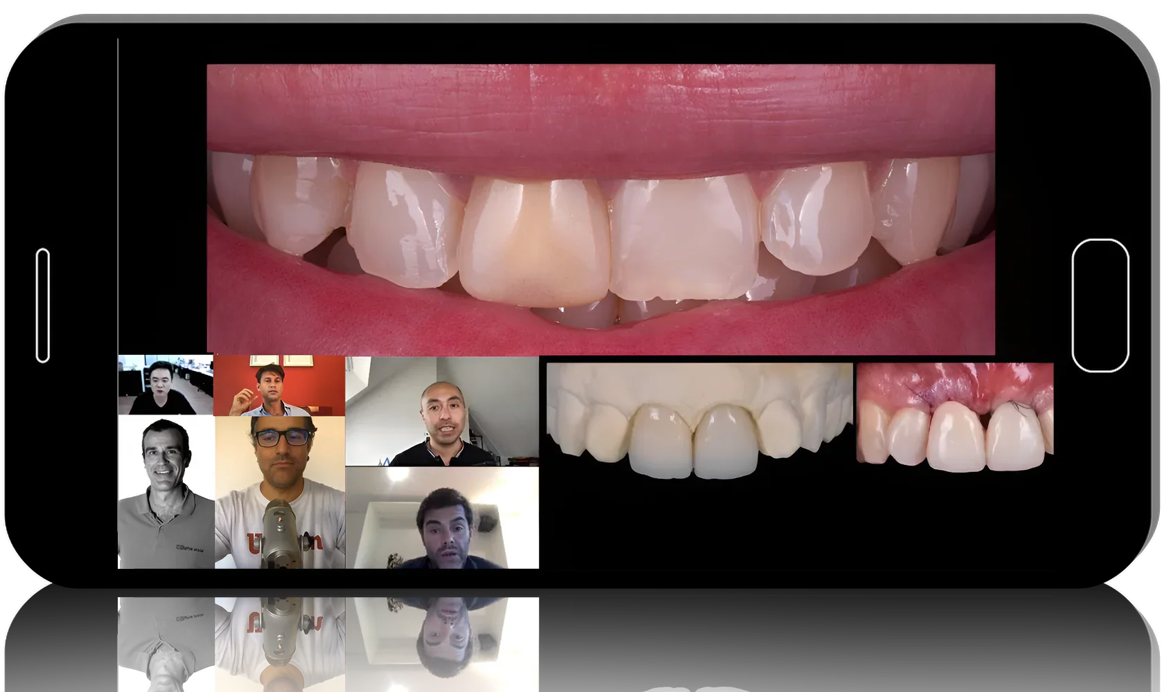 Implant Complications in the Aesthetic Zone