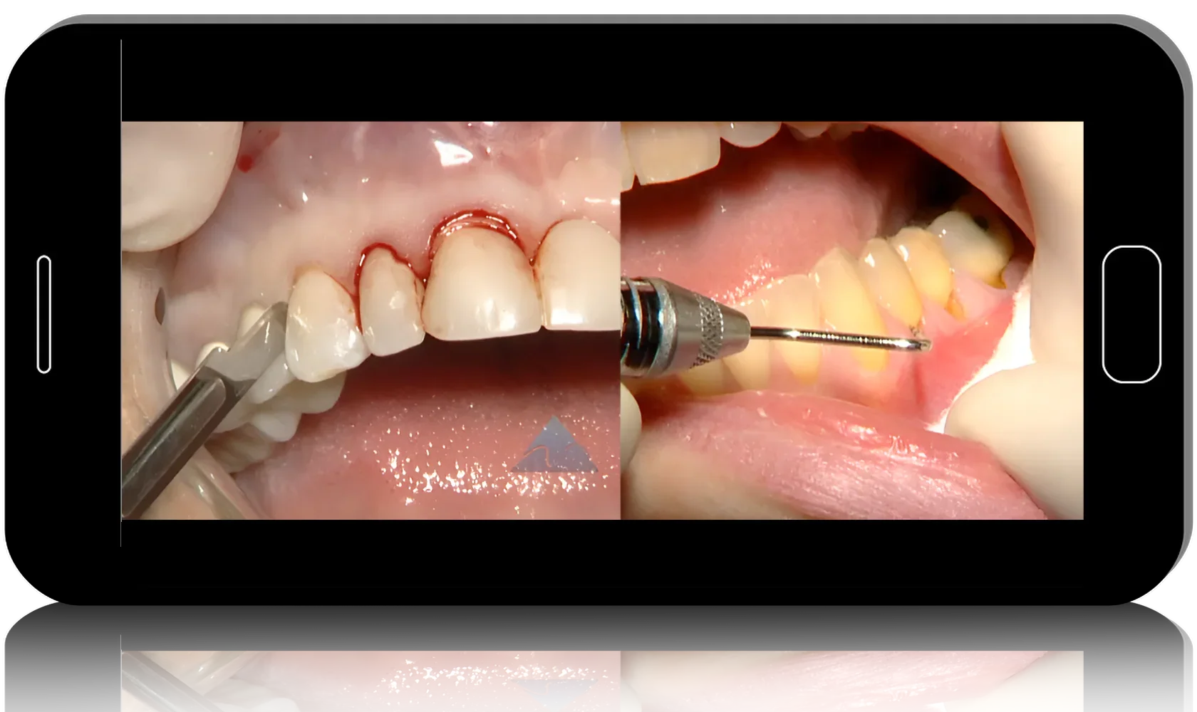 Hard and Soft Tissue Ridge Augmentation and Esthetic Crown Lengthening