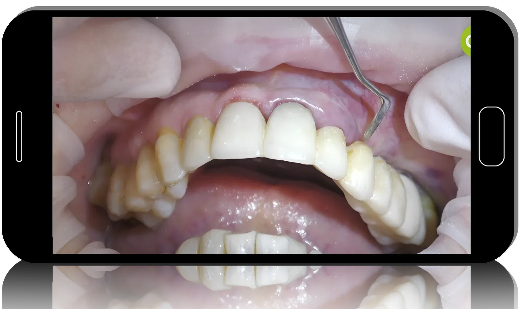 Key Surgical and Prosthetic Considerations for Soft Tissue Management in Immediate and Delayed Implantology