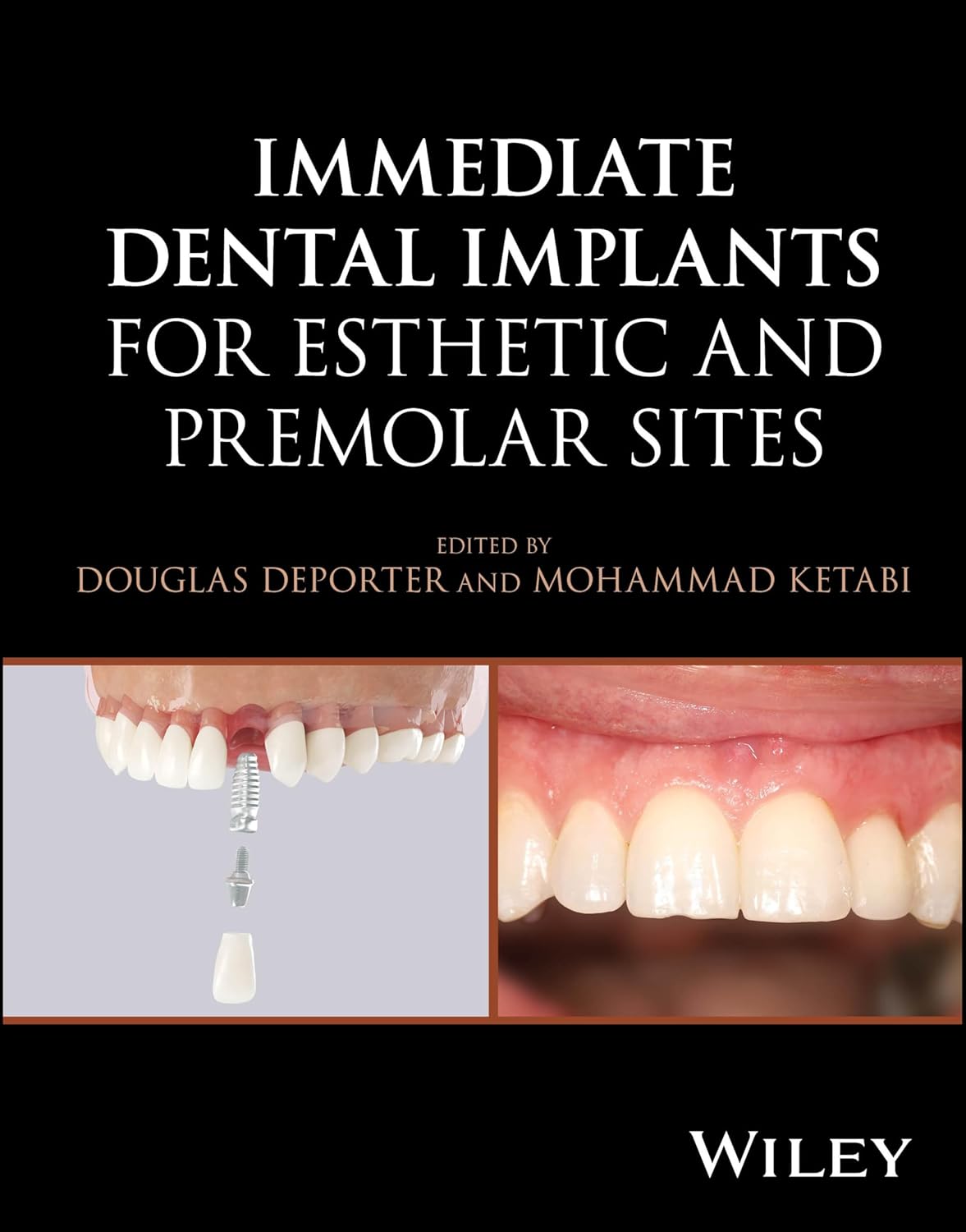 Immediate Dental Implants for Esthetic and Premolar Sites, 1st Edition