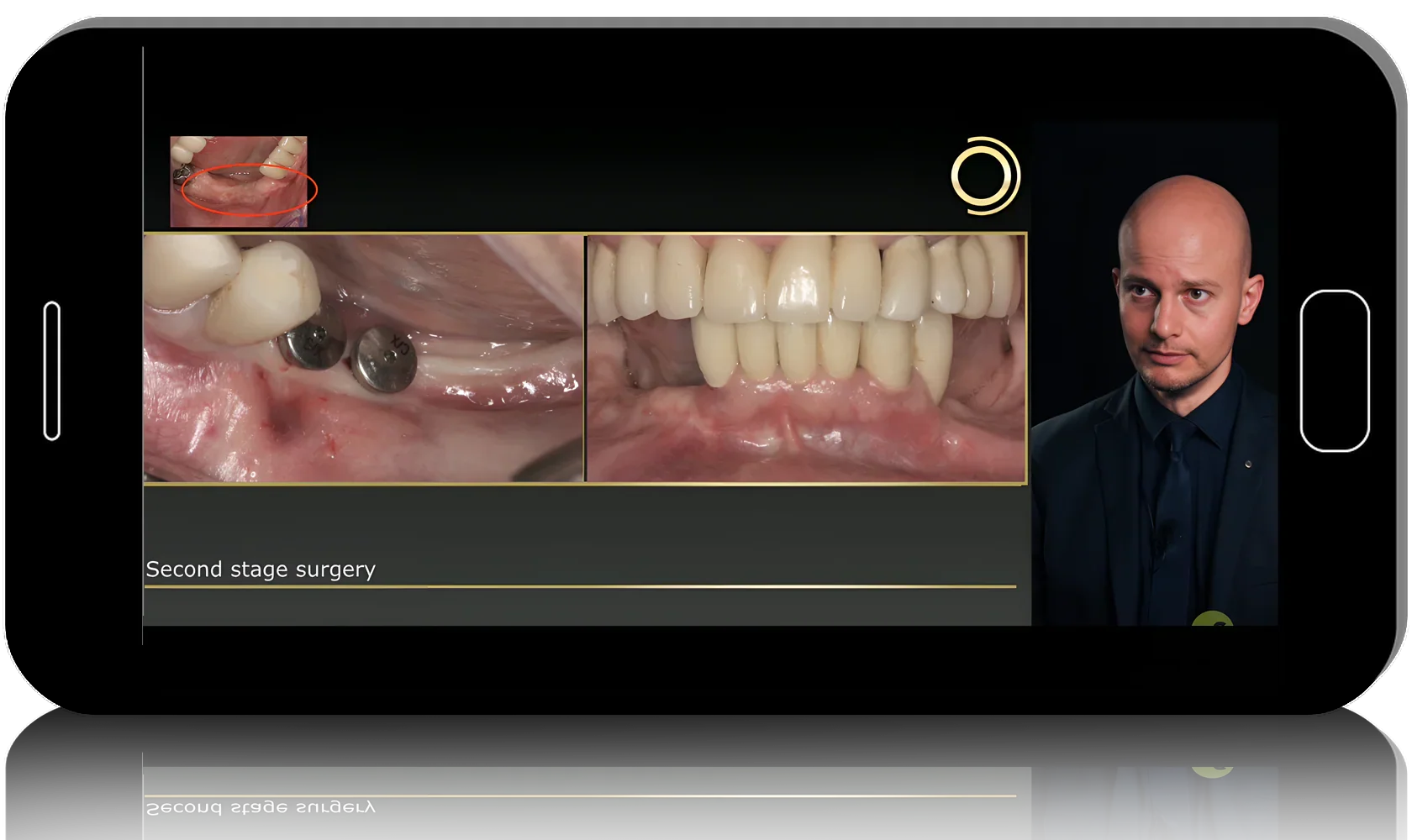 Biological Bone Augmentation