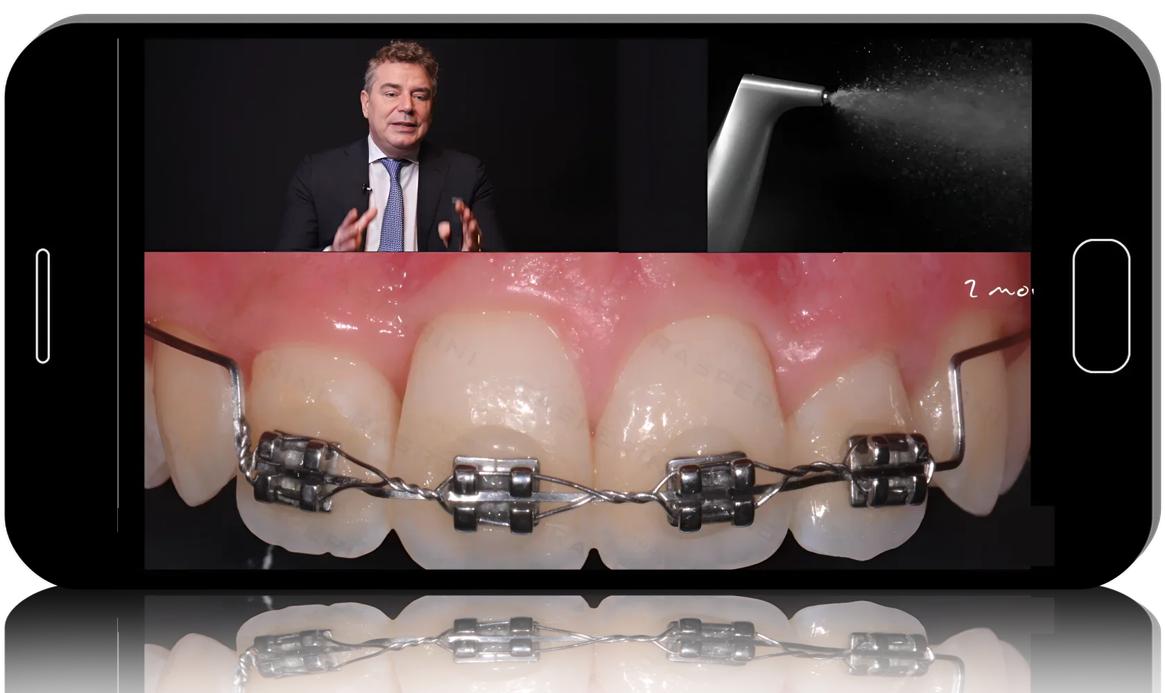 How To Save Teeth With Periodontal Disease