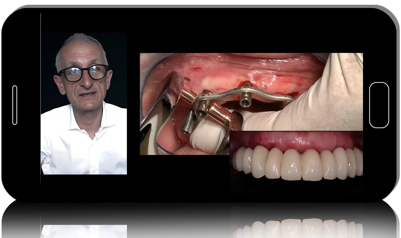 Advanced Immediate Loading: Conometric & Welded Prosthesis Concepts