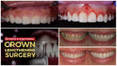 https://dental-books.com/wp-content/uploads/2023/12/Esthetic-and-Functional-Crown-Lengthening.jpg