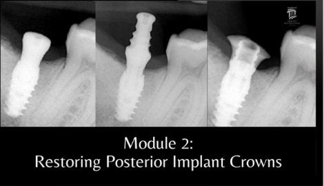 Implant Restorations Simplified: Restore Dental Implants with Accuracy &amp; Confidence (Surgical Master) - Dentistry eBooks
