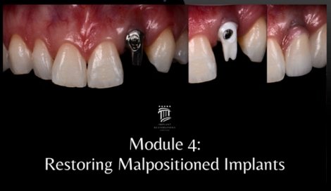 Implant Restorations Simplified: Restore Dental Implants with Accuracy &amp; Confidence (Surgical Master) - Dentistry eBooks