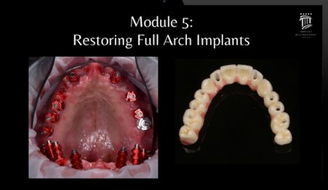 Implant Restorations Simplified: Restore Dental Implants with Accuracy &amp; Confidence (Surgical Master) - Dentistry eBooks