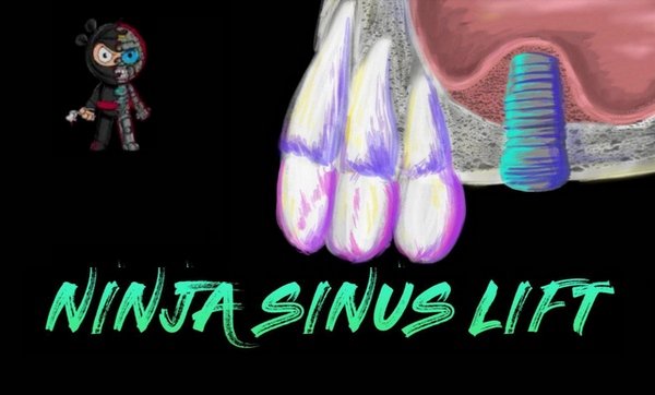 Ninja Sinus Lift Course - Dentistry eBooks