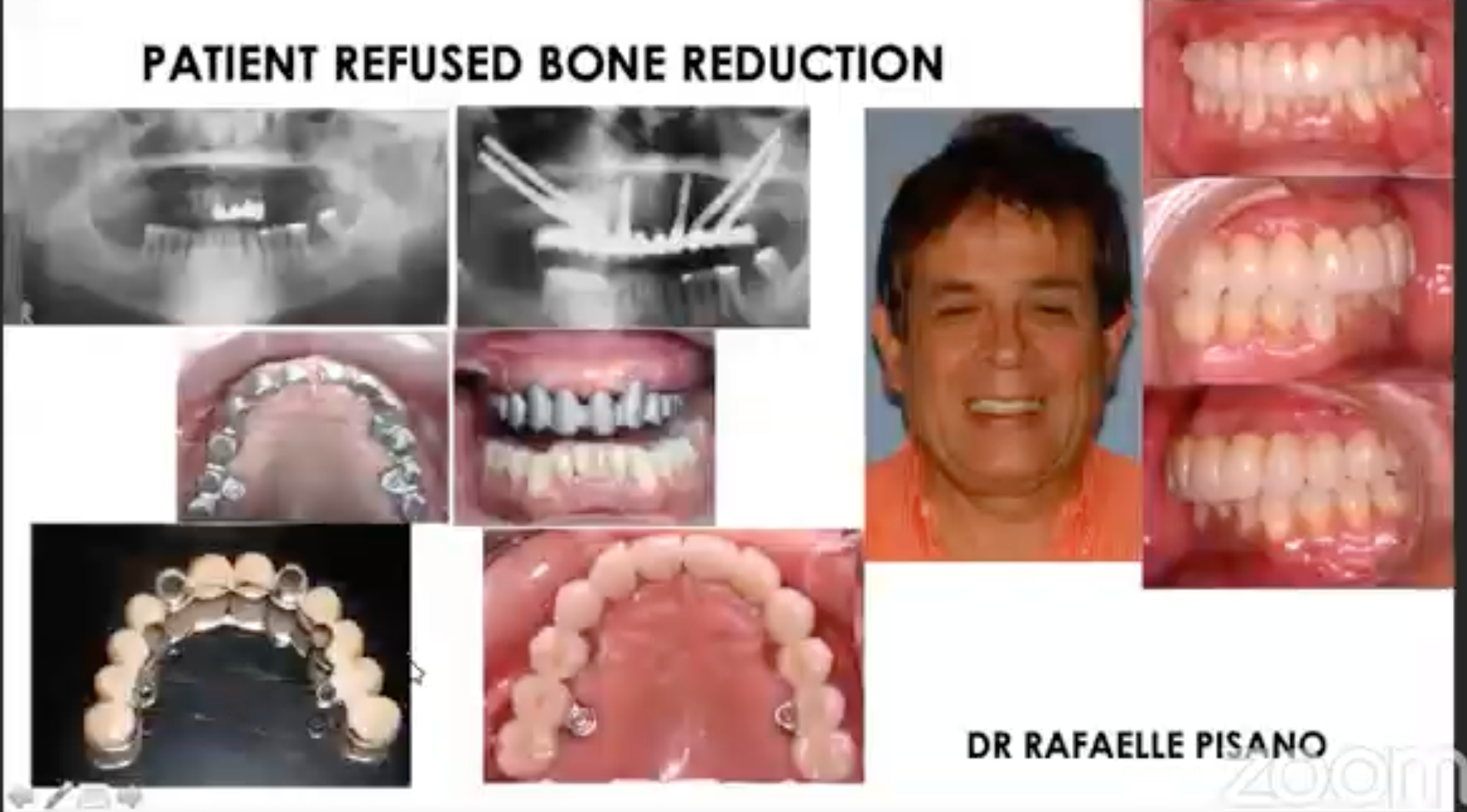 How to Avoid Complications in Zygoma Implant Surgery