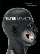 https://dentalmp4.com/wp-content/uploads/2024/11/Tilted-Implants.jpg