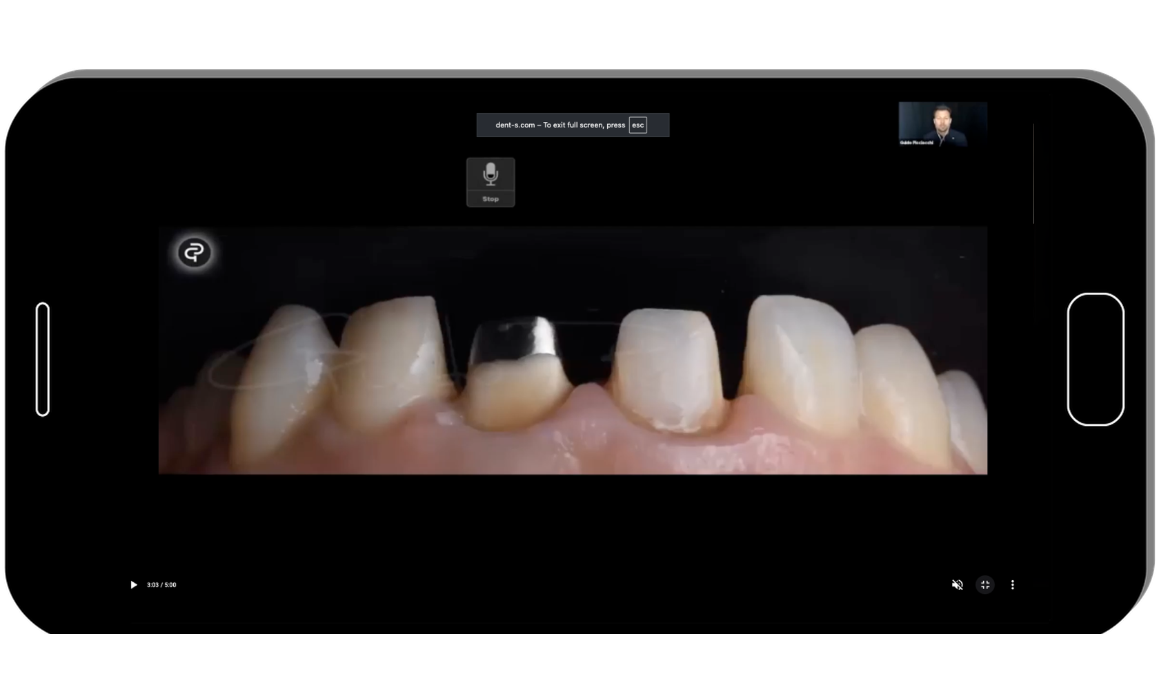 Implant Aesthetics, How to Select Connections and Digital Solution
