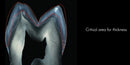 https://dentalmp4.com/wp-content/uploads/2022/06/Vertical-preparation-protocols-2.jpg