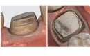 https://dentalmp4.com/wp-content/uploads/2022/06/Vertical-preparation-protocols-3.jpg