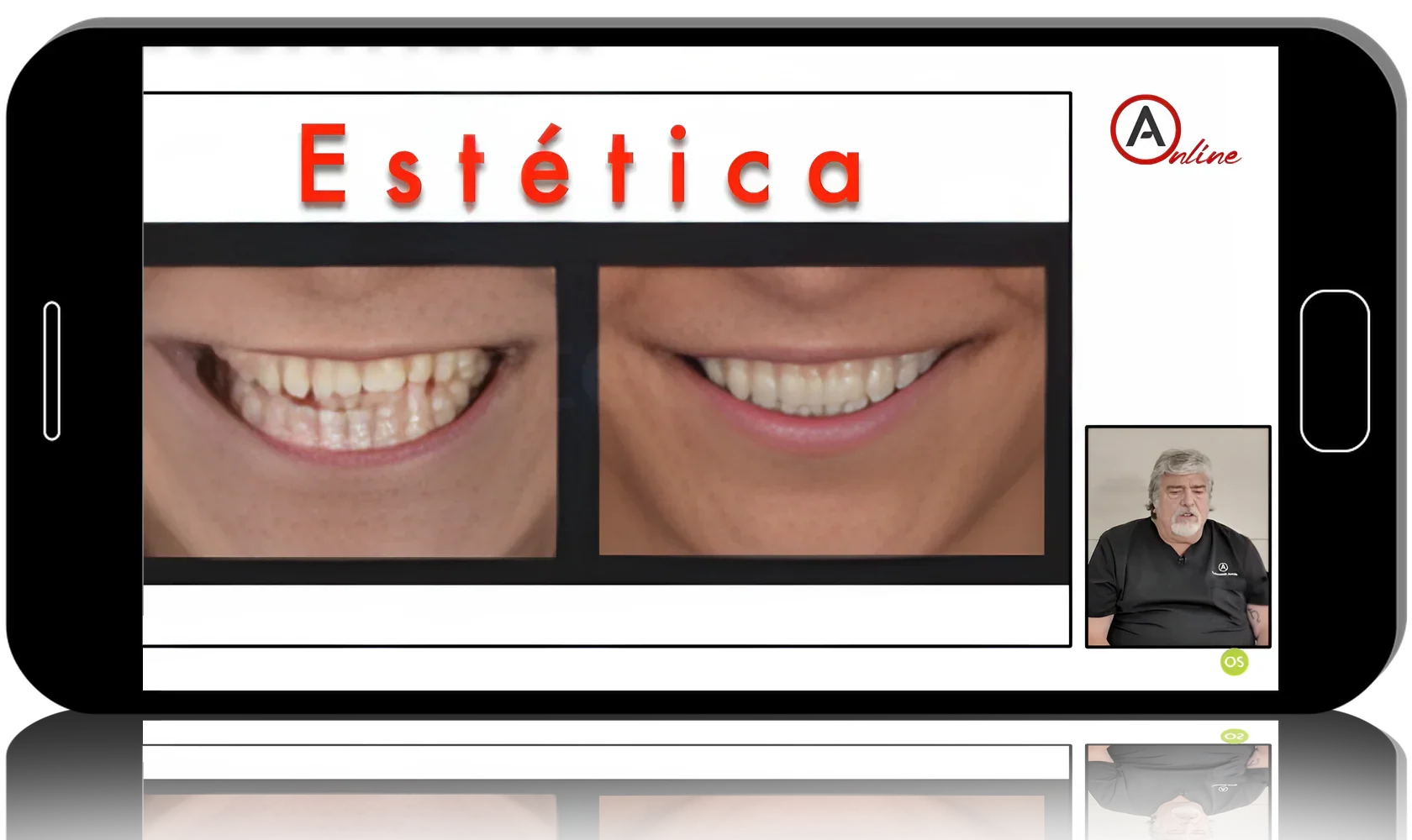 Direct Anterior Composite Restorations