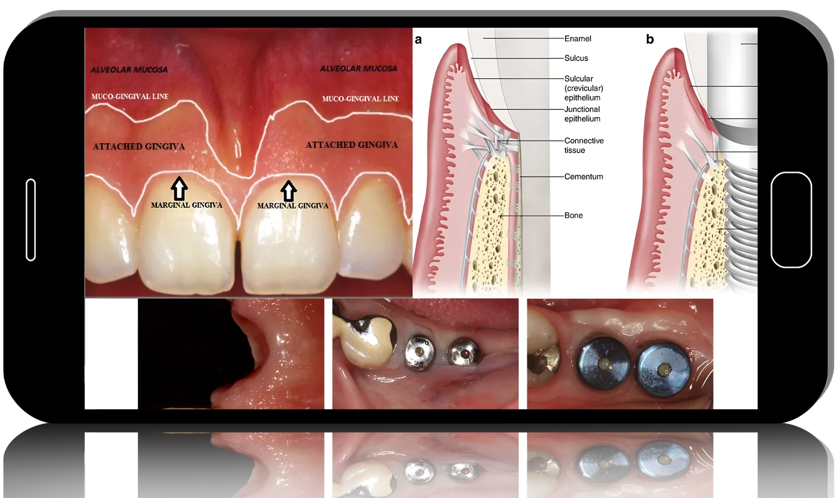Soft Tissue Management for Implants, The Complete Course