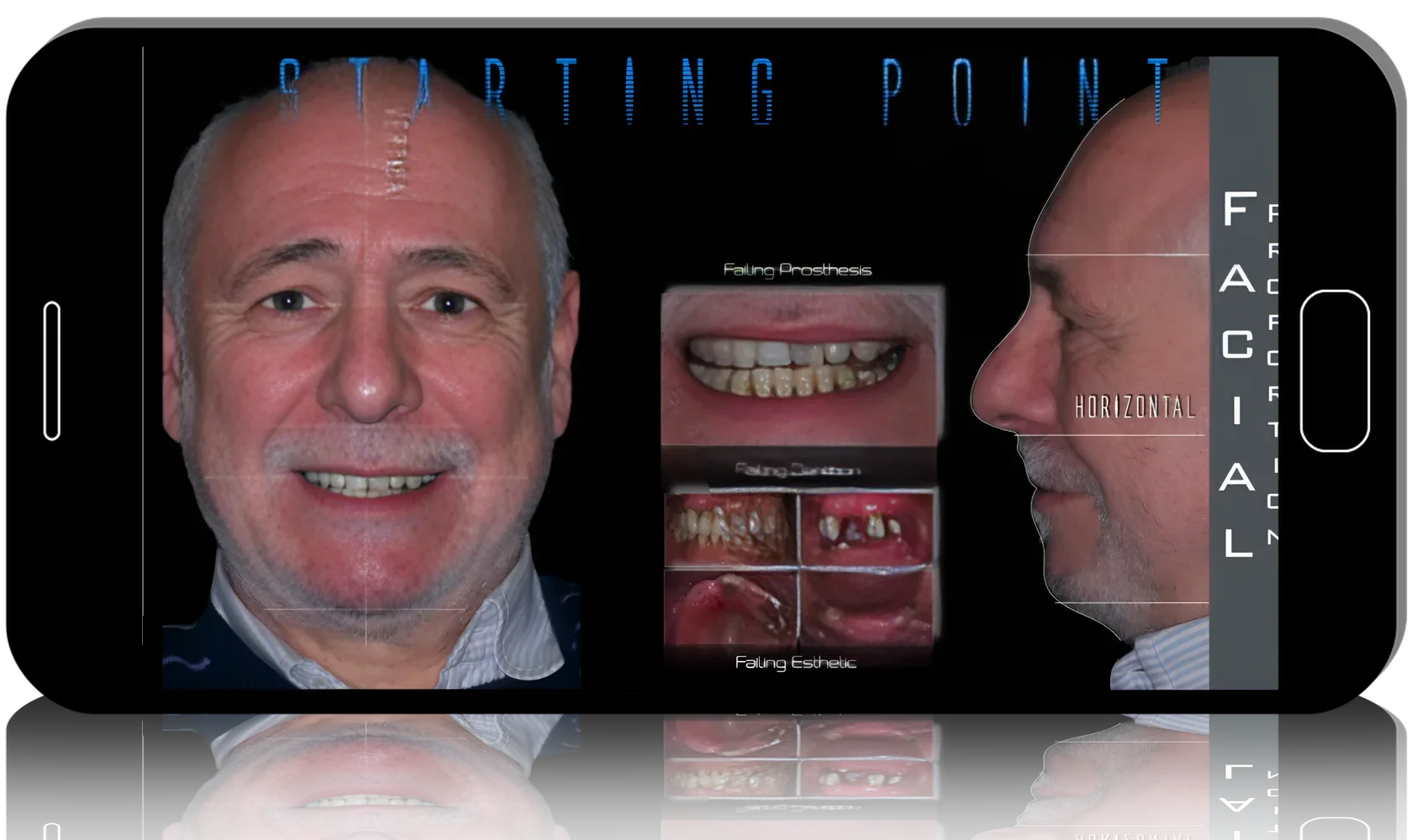 Full-arch rehabilitation. Implantation and prosthetics