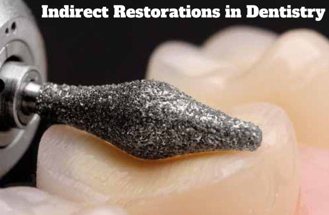 Indirect Restorations in Dentistry – A Complete Guide - Dentistry eBooks